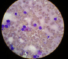 Microscopic slide of a mast cell tumour